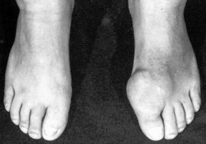 A foot with gout. Black men suffer from higher rates of gout because of high blood pressure and the oral medications needed to treat disease.