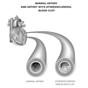 blood-clot-plaque-thrombosi