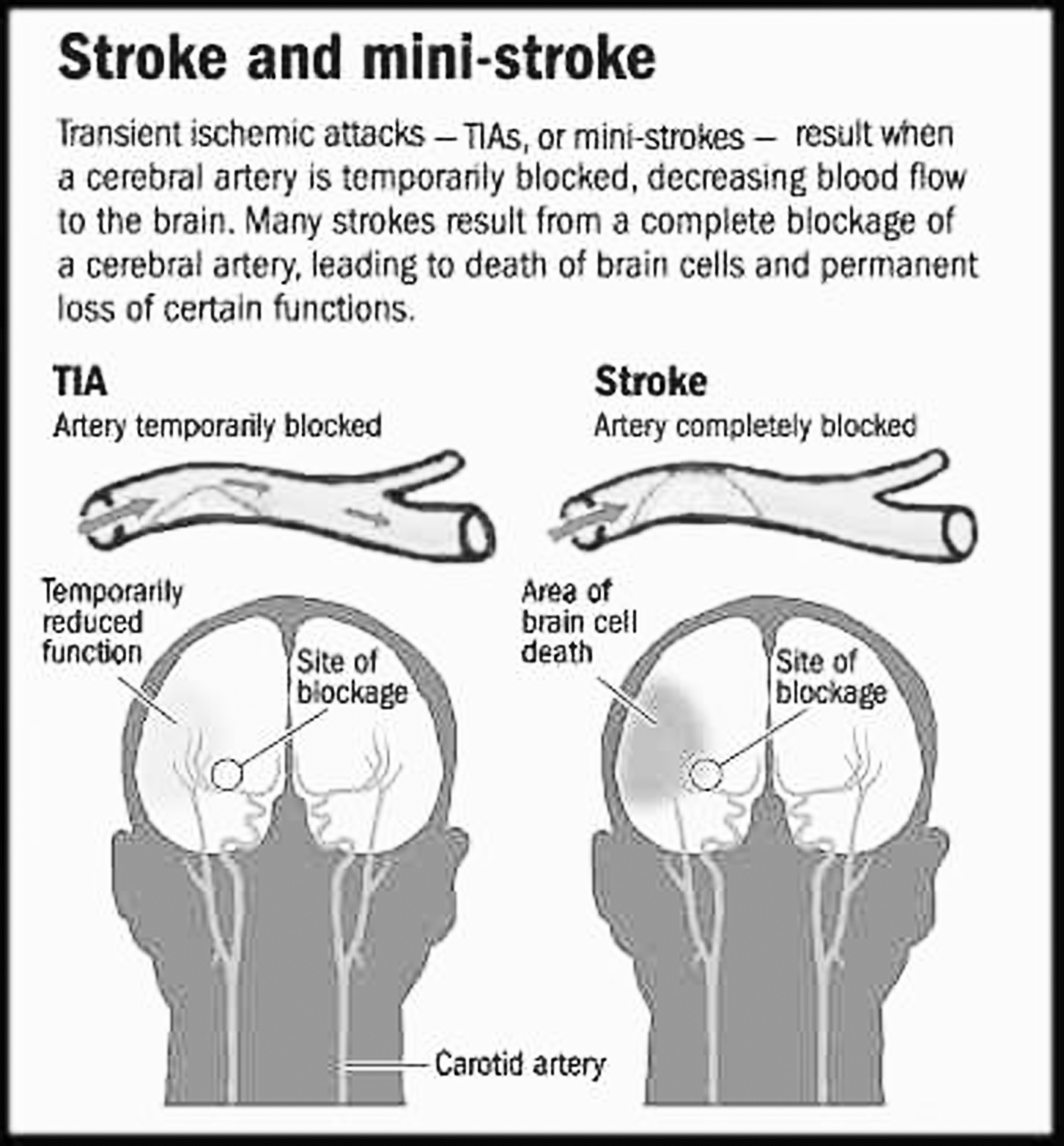 stroke-ministroke-031918-new-orleans-multicultural-news-source-the