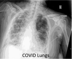 COVID-19-lungs-051120